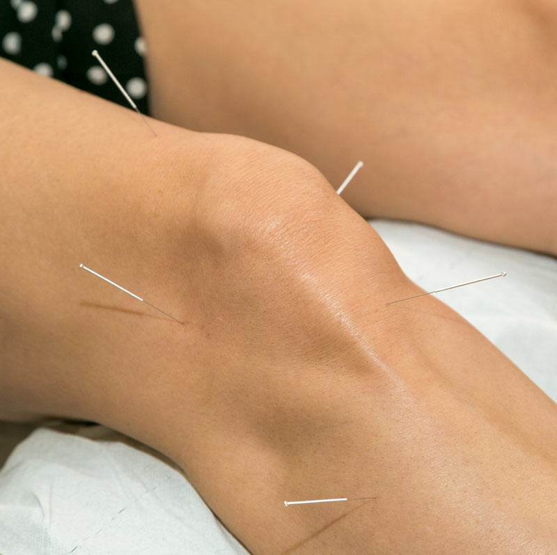 acupuncture-perpignan-pyrenees-orientales-66